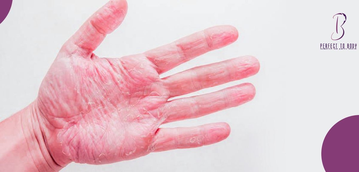 علاج جفاف اليدين وتشققها