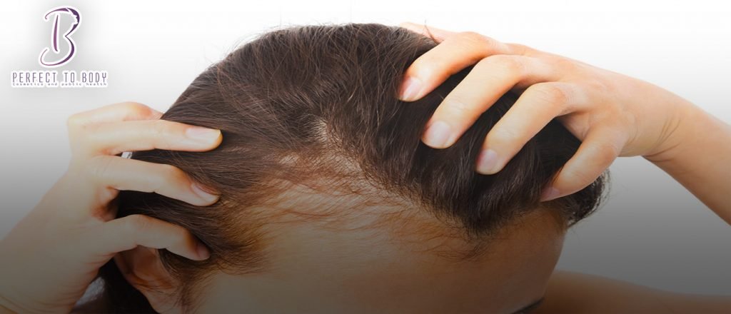 علاج فراغات الشعر الأمامية للنساء طبيا برفكت توبادي - perfect2body.com