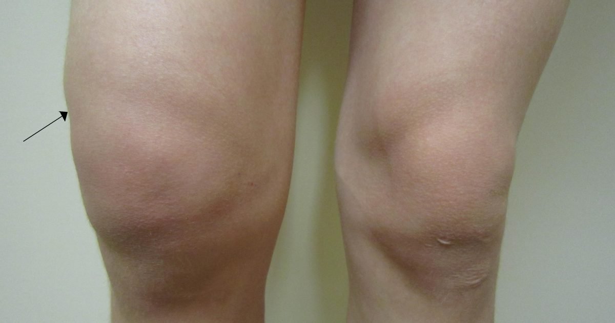 ما هو علاج انتفاخ الركبة بالأعشاب؟